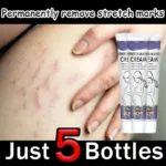 Gentle Skin Care Improves Elasticity Effective After Pregnancy Stretch Marks Removal Powerful Maternity Cream Nourishes Skin - Image 6