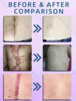 Scar Removal Cream Remove Keloid Surgical Burn Scald Caesarean Section Scars - Image 5