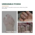 Hand Ringworm Beriberi Fungus Spray Hand and Foot Skin Care Anti Itch Spray 20ml Itching Disinfect Personal Health Care - Image 3