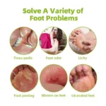 Foot Odor Tinea Pedis Treatment Spray Remover Feet Sweat Beriberi Athlete Foot Peeling Anti Fungal Itch Inhibits Fungus Medicine - Image 2