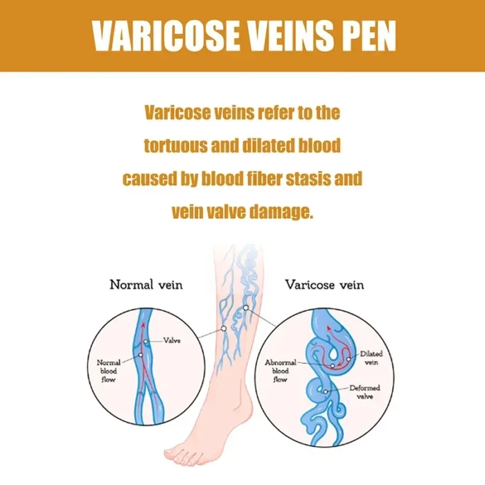 Xiaomi Therapy Leg Repair Pen Improving Blood Circulation Varicose Veins Relieves Leg Bulge Discomfort Pen Skin Care Product New - Image 5