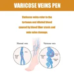 Xiaomi Therapy Leg Repair Pen Improving Blood Circulation Varicose Veins Relieves Leg Bulge Discomfort Pen Skin Care Product New - Image 5