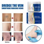 Leg Vein Repair Cream Varicose Massage Earthworm Leg Pain Swelling Huoluomaikang Antibacterial Topical Body Care Cream - Image 3
