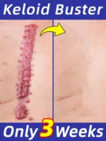 Scar Removal Cream Remove Keloid Surgical Burn Scald Caesarean Section Scars