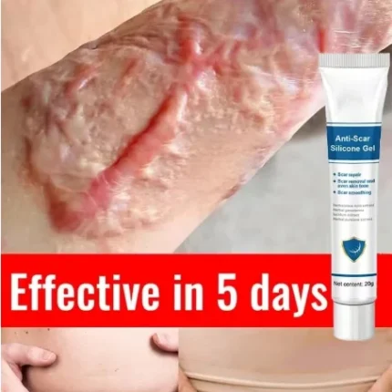 Eliminate Red White Old Stretch Marks Cream For Pregnancy Postpartum Skin Care Gel