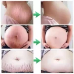 7 Days Stretch Marks Spray For Pregnancy Remove Postpartum Obesity Women Scar Without Side Effect Butt Firm Lift Skin Body Cream - Image 2