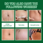 7 Days Stretch Marks Spray For Pregnancy Remove Postpartum Obesity Women Scar Without Side Effect Butt Firm Lift Skin Body Cream - Image 4