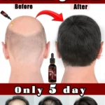 Hair essential oil massage comb, applicator + essence, accelerate hair growth, thick hair in 5 days